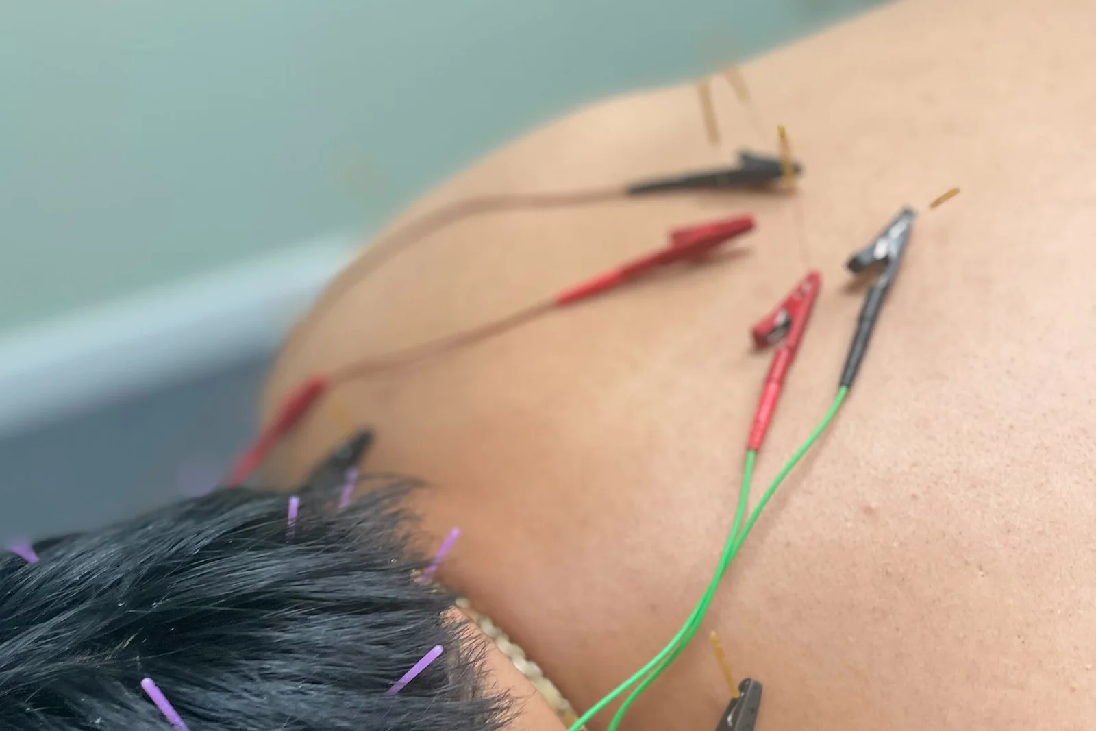 Dry Needling in Jacksonville, FL